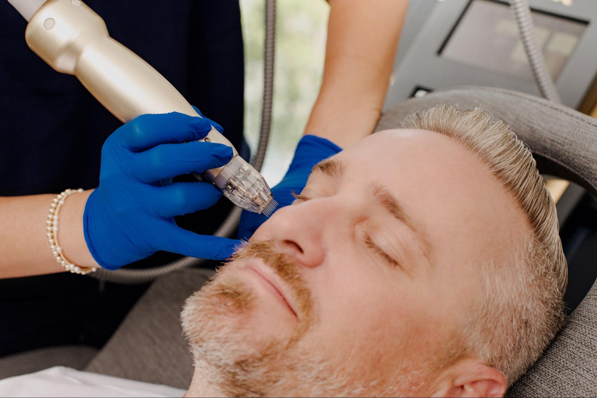 Sylfirm X RF microneedling