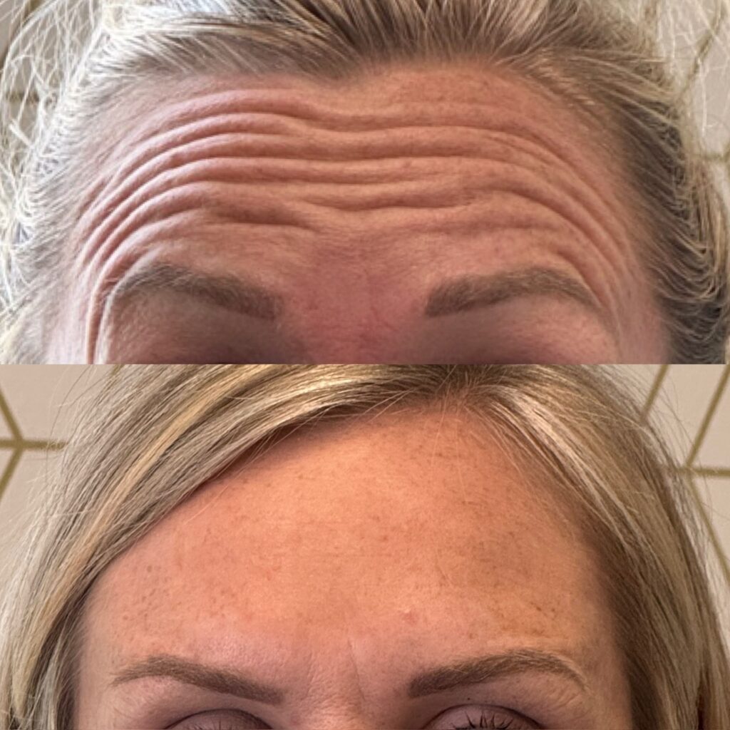 Botox