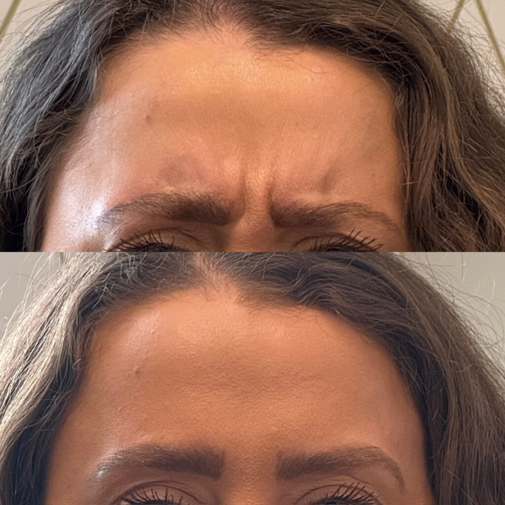 Botox