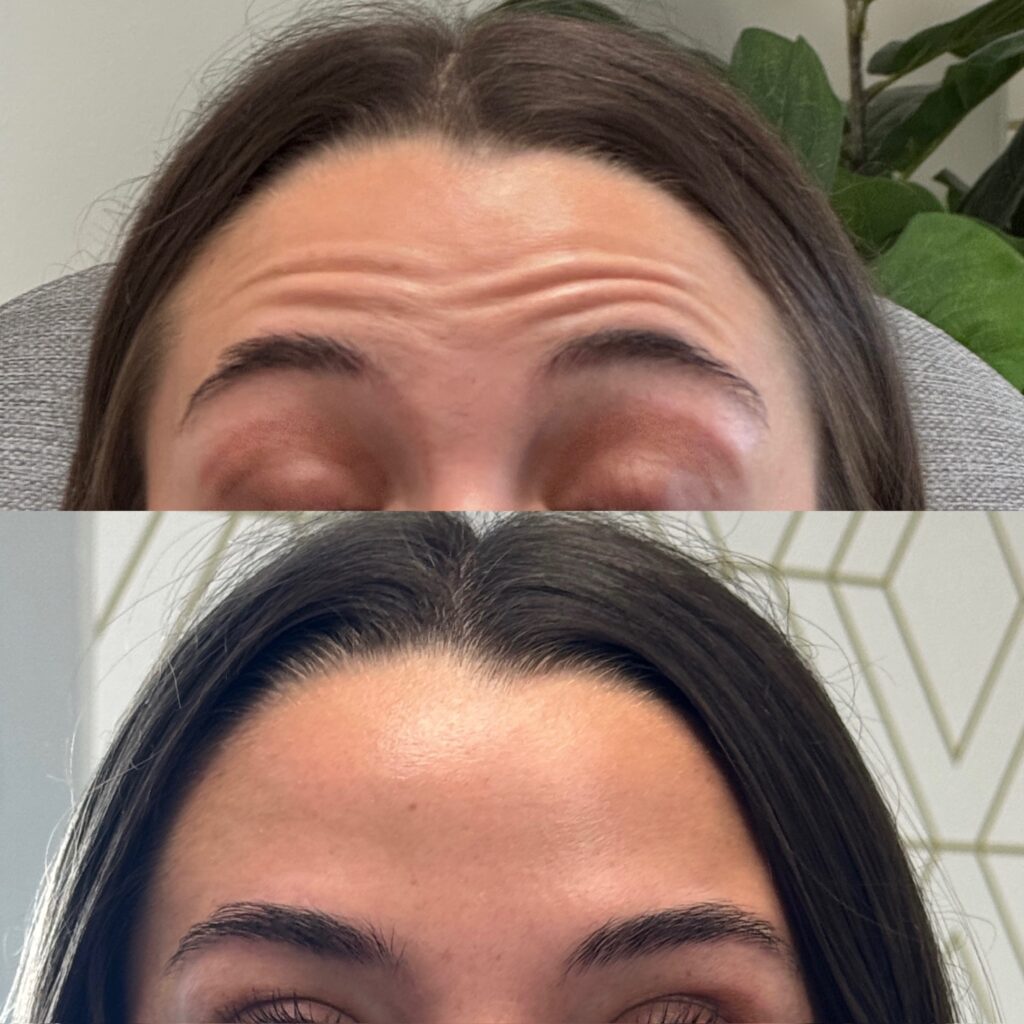 Botox