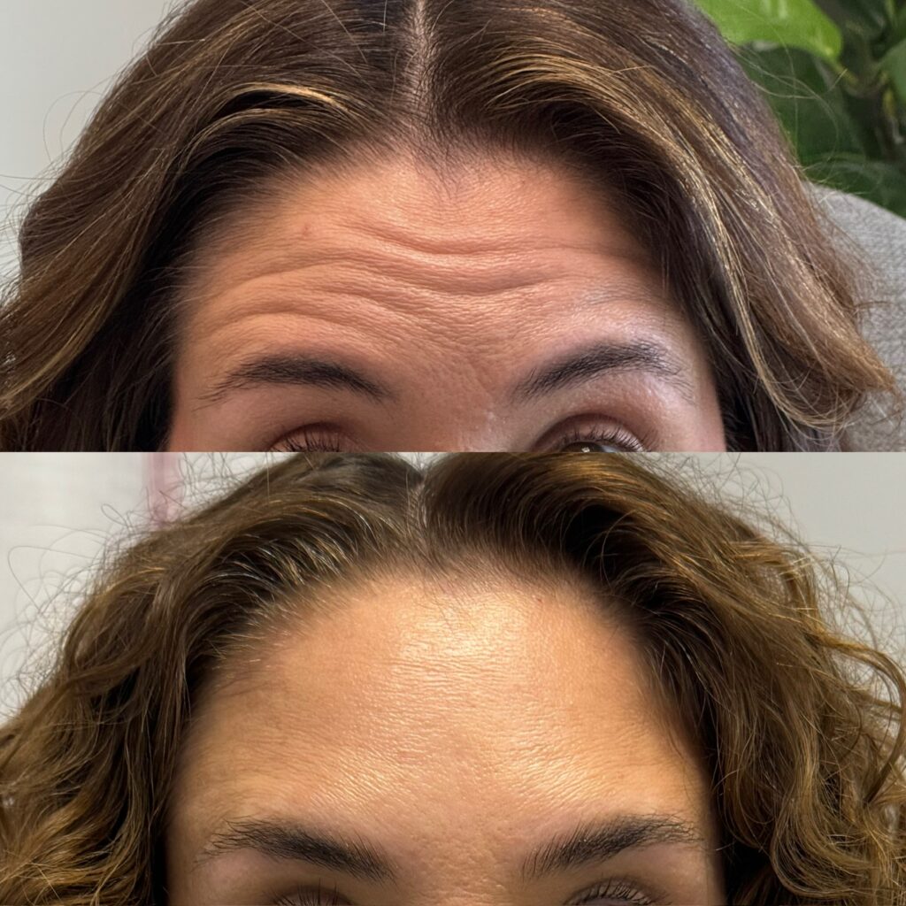 Botox